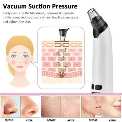 Electric Blackhead Remover Vacuum